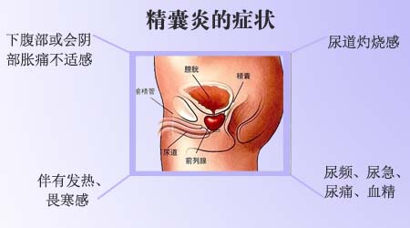 精囊炎图片,精囊炎症状,精囊炎治疗,精囊炎危害