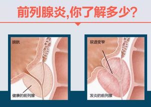 西安男科医院|前列腺有什么功能?前列腺炎症有什么危害?