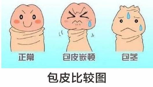 包皮包茎图片,包皮包茎区别,包皮包茎手术,包皮包茎危害