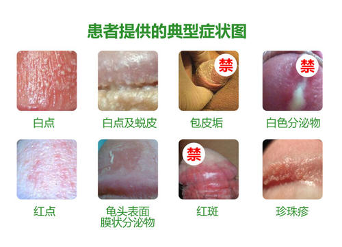 包皮过长危害,包皮过长图片,包皮过长早泄,包皮过长原因